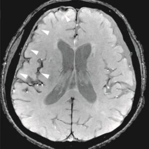 LONGEVITY NEXUS: The Ghost in the MRI: When AI Sees What Doctors Don’t